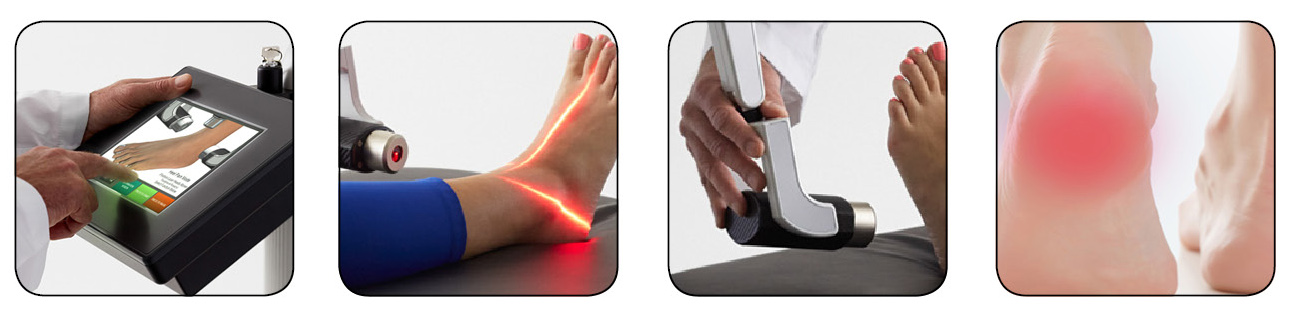 laser treatment for plantar fasciitis cost