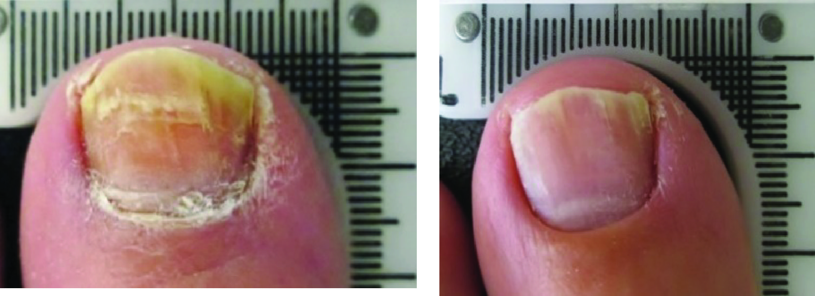 Lunula Laser B & A_Patient 002 & 100 - Erchonia