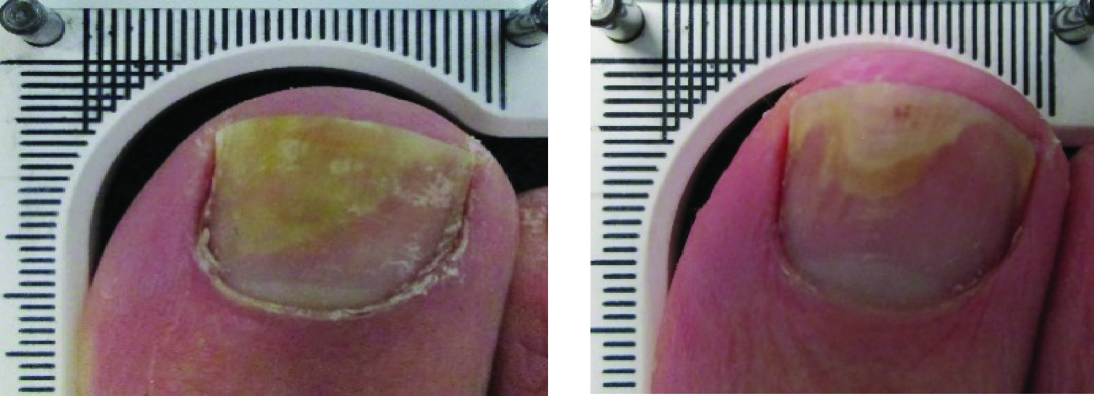 Lunula Laser B & A_Patient 033 & 111 - Erchonia Corporation