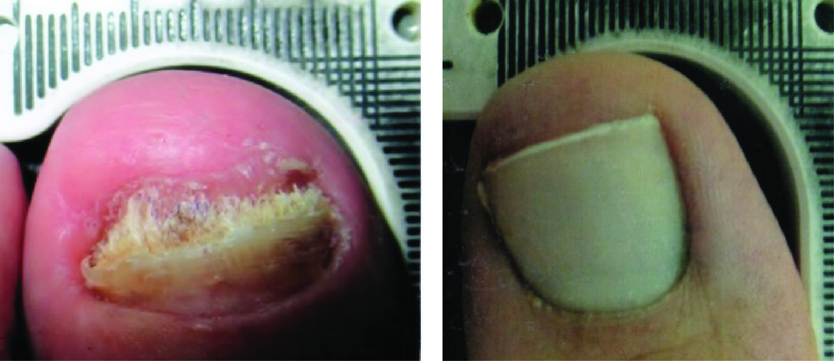 Lunula Laser B & A_Patient 034 & 150 - Erchonia Corporation