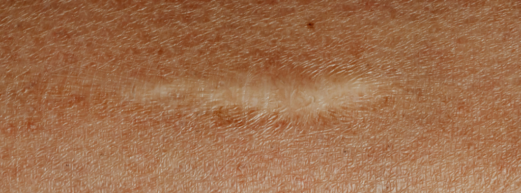 How Laser Treatments are Revolutionizing Scar Reduction and Healing